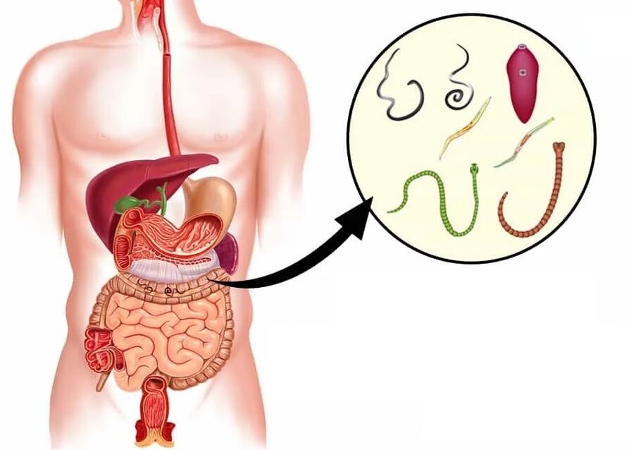 Vermixin ajuda com a maioria dos tipos de helmintos