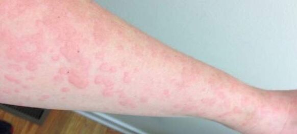 As alergias cutâneas são um sinal da presença de parasitas no corpo